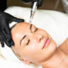 microneedling