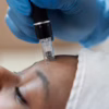 microneedling