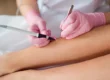 electrolysis hair removal Fort Lauderdale