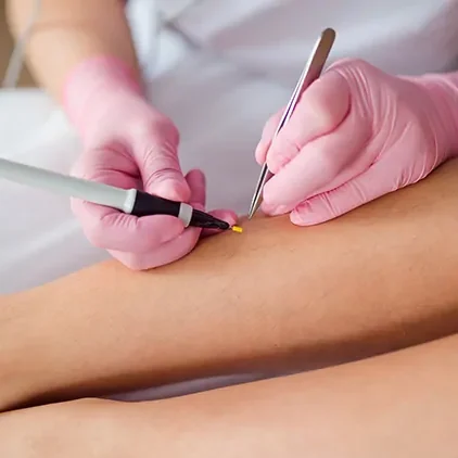 electrolysis hair removal Fort Lauderdale