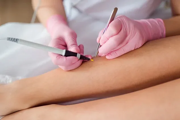 electrolysis hair removal Fort Lauderdale