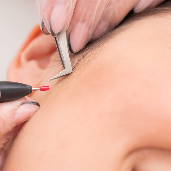 electrolysis oakland park fl